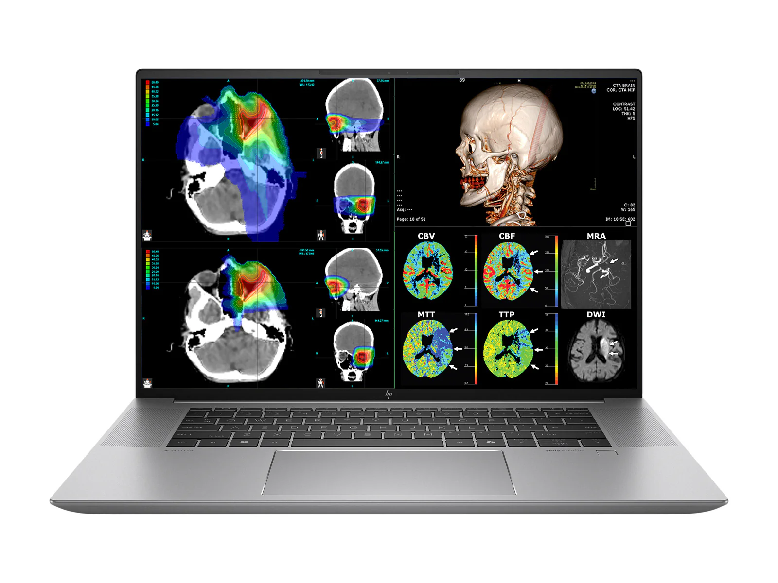 HP ZBook Studio 16 G11 Mobile Radiology Workstation | 16" WUXGA DICOM Calibrated | Intel Core Ultra 7 155H @ 4.8GHz | 16-core | 16GB DDR5 | 512GB NVMe SSD | RTX 1000 Ada 6GB | WiFi 7